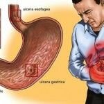 Tratamiento para la gastritis nerviosa por estrés