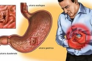 gastritis nerviosa