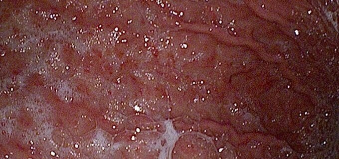 Síntomas y causas de la gastritis erosiva