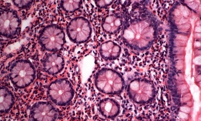Tratamiento para la gastritis eosinofílica