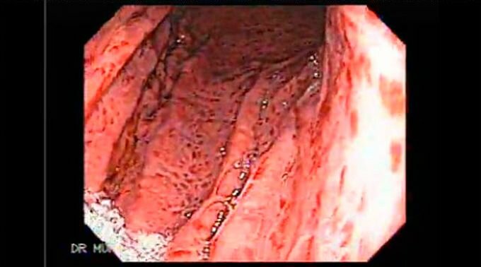Tratamiento de la pangastritis o gastritis entera
