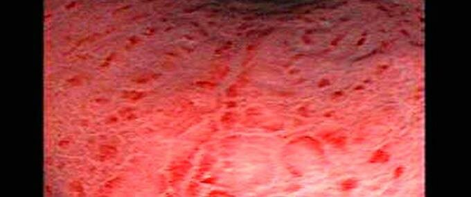 Que es la gastritis folicular: síntomas y causas