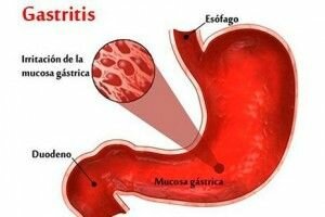gastritis Autoinmune