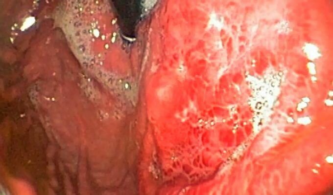 Tratamiento de la gastritis fúndica